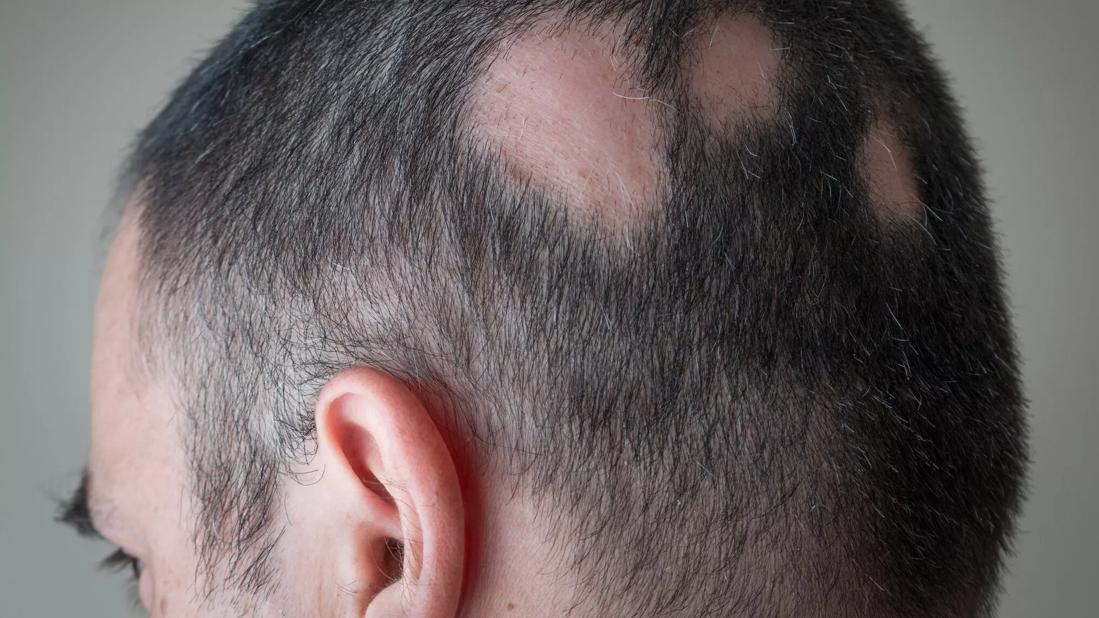 Alopecia Areata Self-Care and Stress Management