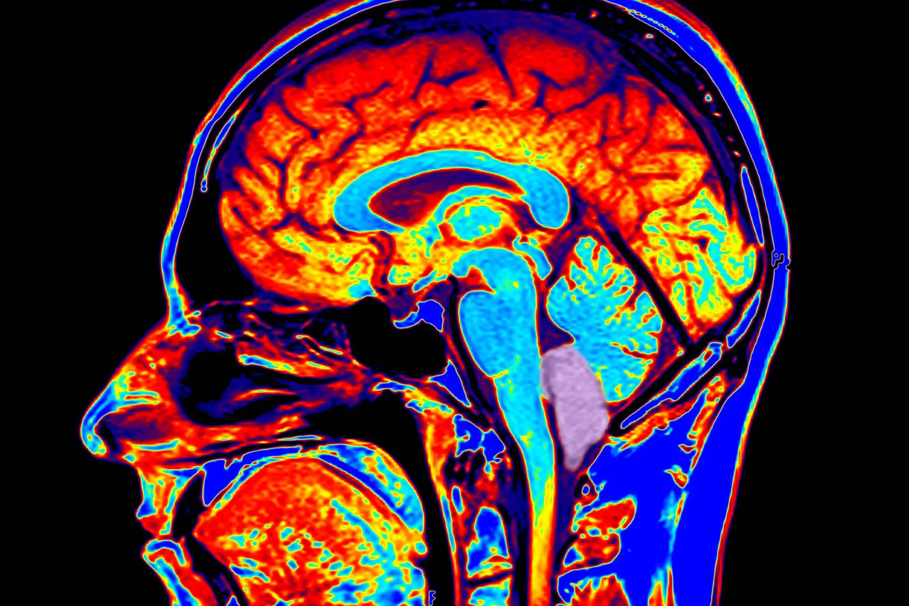 Chiari Malformation: Symptoms, Types and Treatment