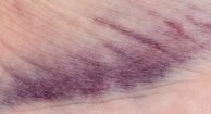 Low Platelet Count (Thrombocytopenia)