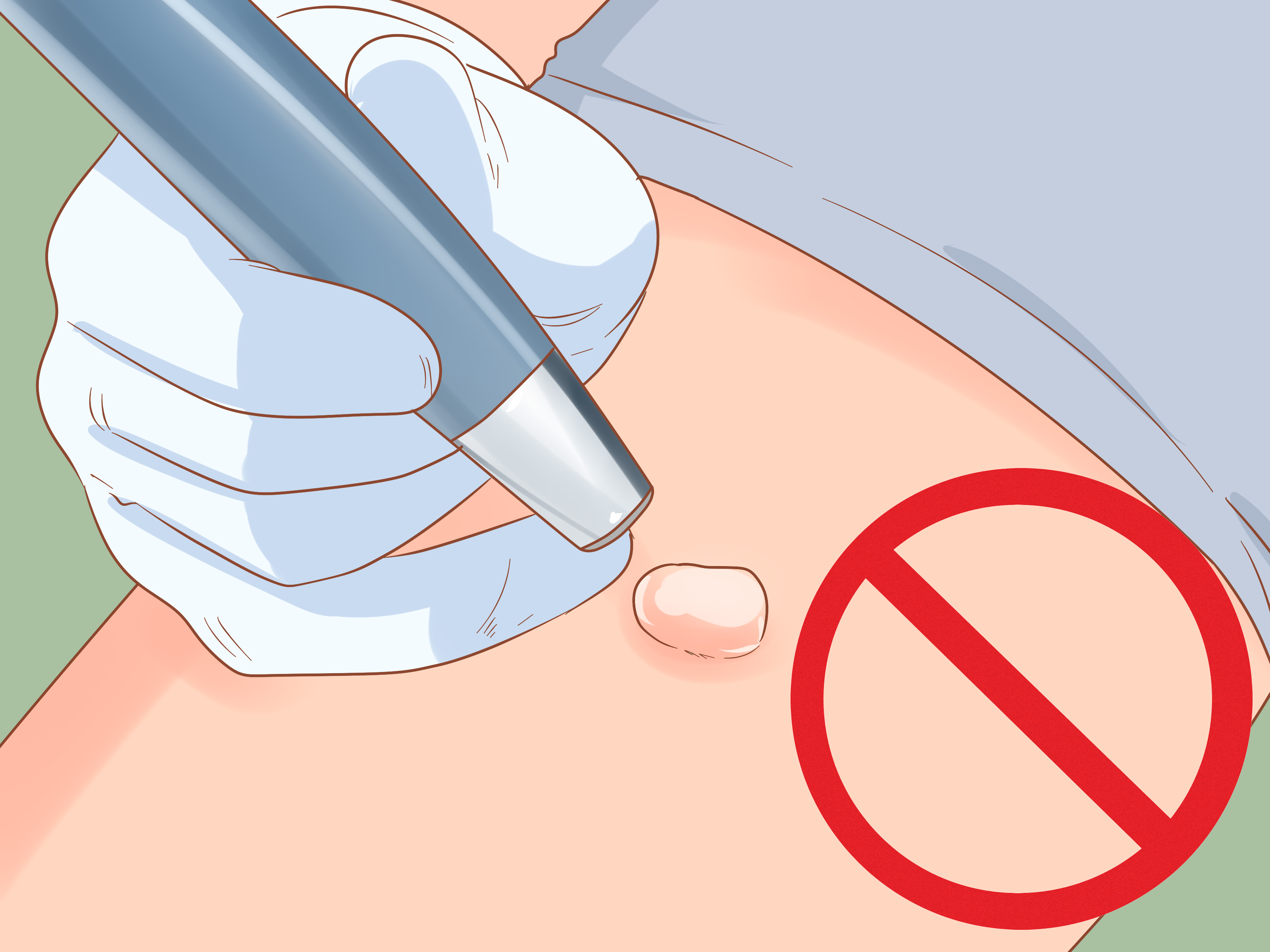 How to Stop a Keloid from Growing: 10 Steps