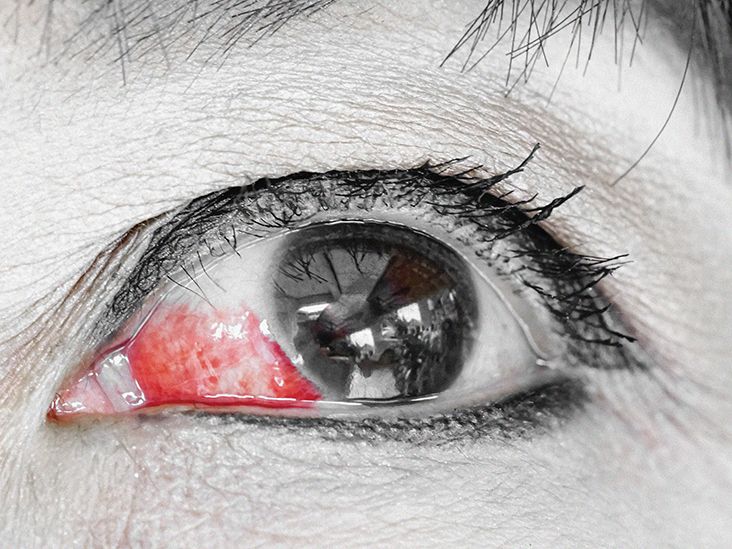 Eye Bleeding: Types, Causes, Treatment, and Seeking Help