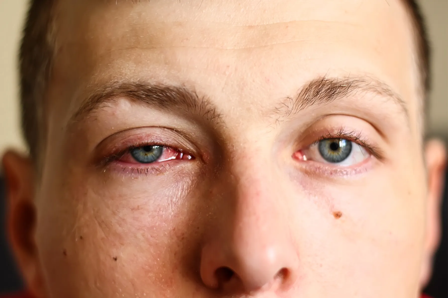 How to Get Rid of Pink Eye: Home Remedies and Treatment